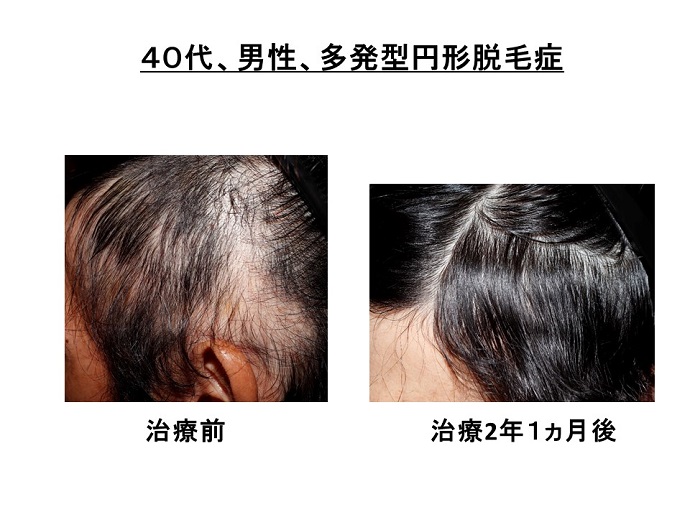円形脱毛症　病院